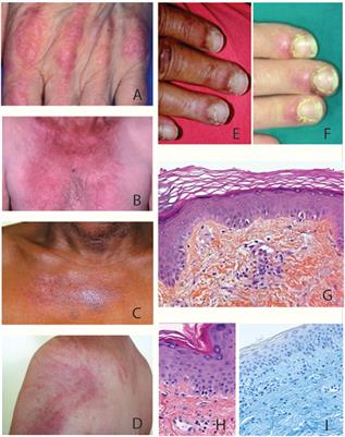 Dermatomyositis patients Dermatomyositis patients